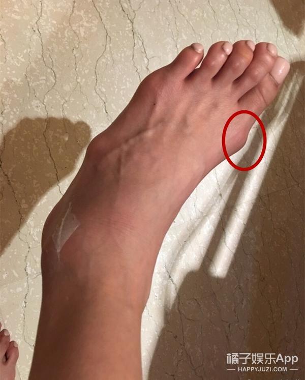 贝嫂拇指外翻手术_容祖儿拇指外翻_女明星的脚趾头最美